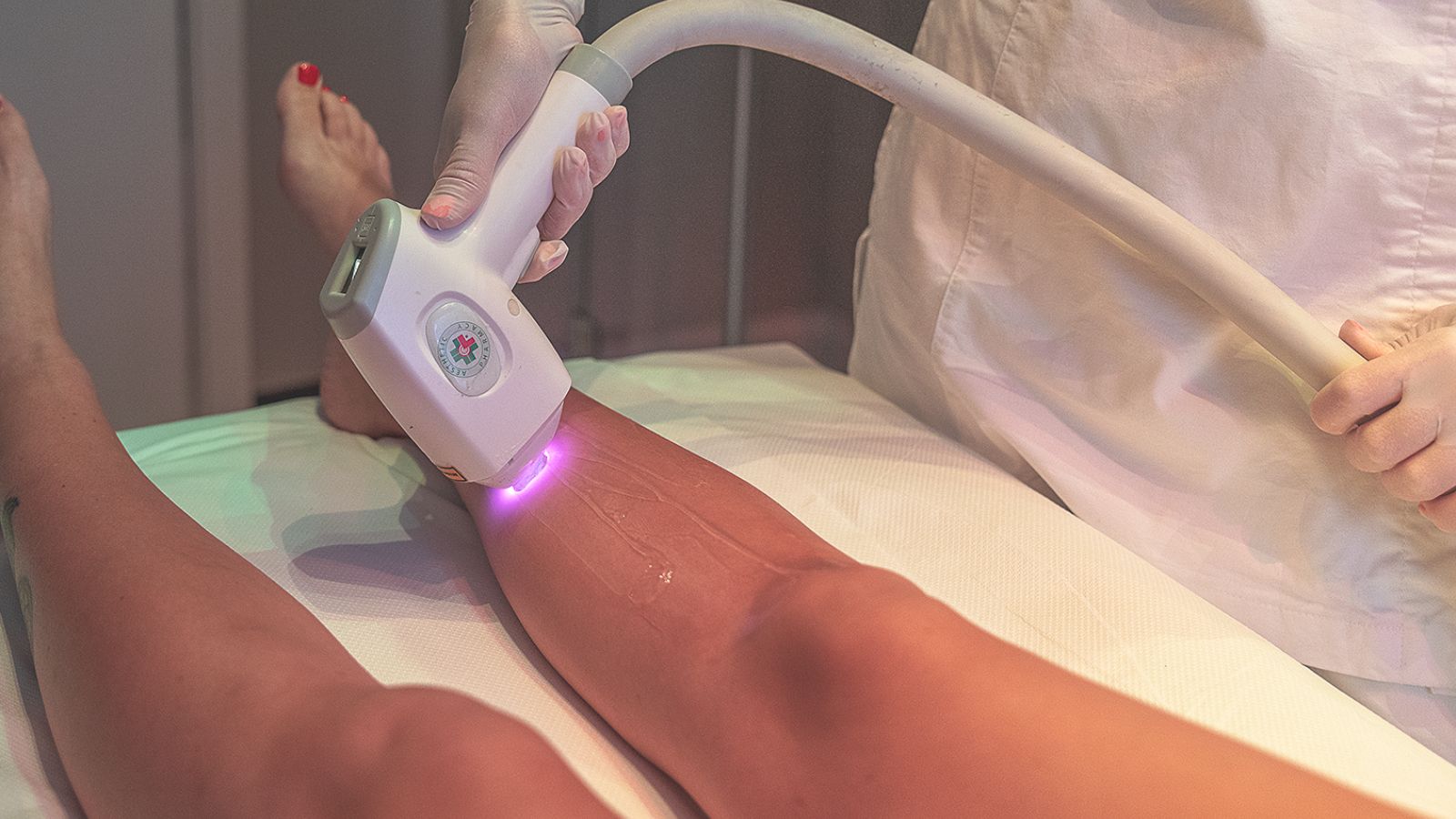 epilazione laser