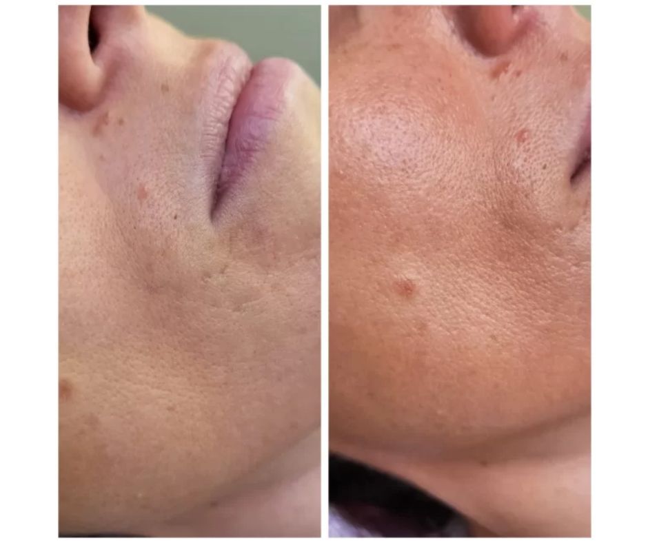 trattamento con esosomi